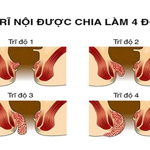 Bệnh trĩ nội là gì? Triệu chứng chính, nguyên nhân, cách điều trị dứt điểm