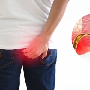 Trĩ có mấy cấp độ ? Các giải pháp xử lý dứt điểm bệnh trĩ như thế nào ?